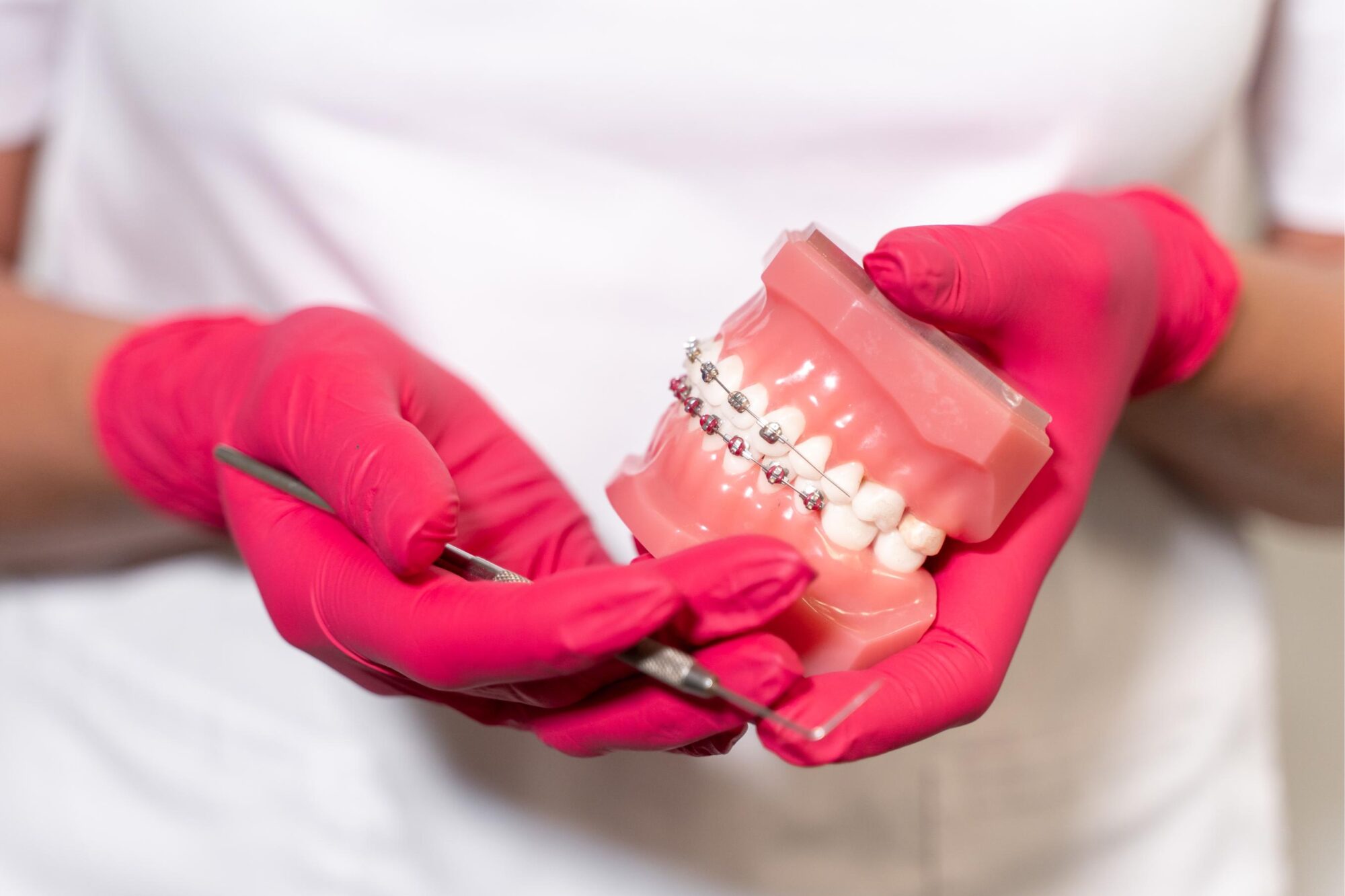 Can Braces Fix an Underbite?