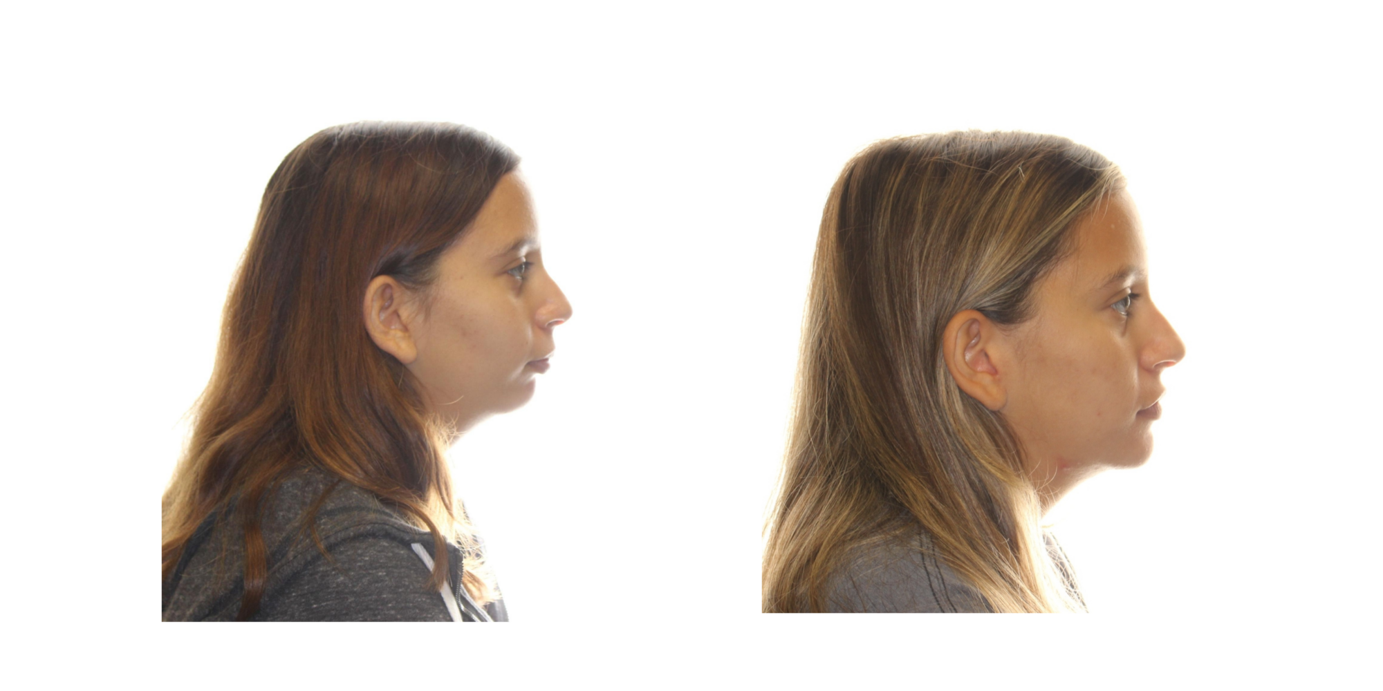Can Braces Fix an Overbite?